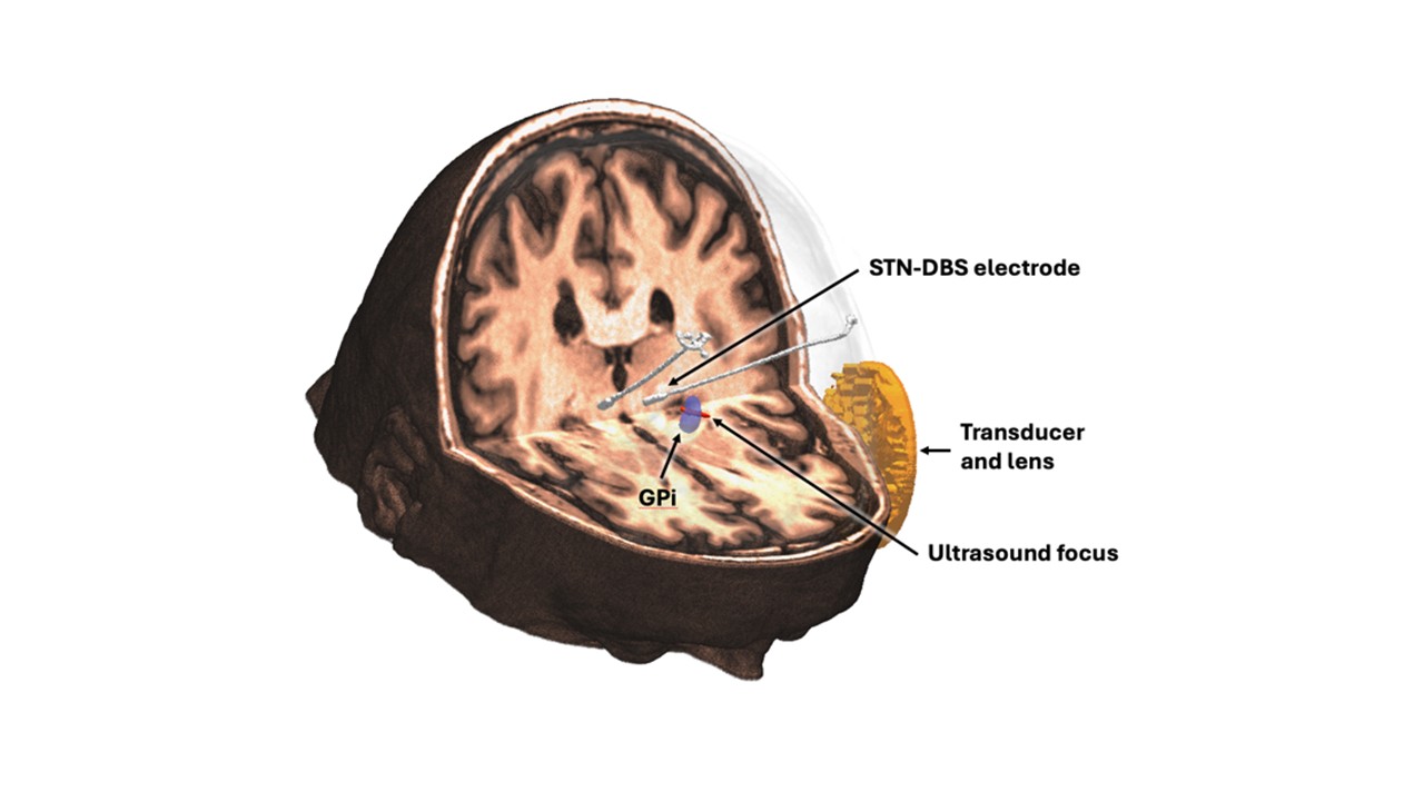 Graphic showing how transcranial ultrasound works by targeting sites deep in the brain