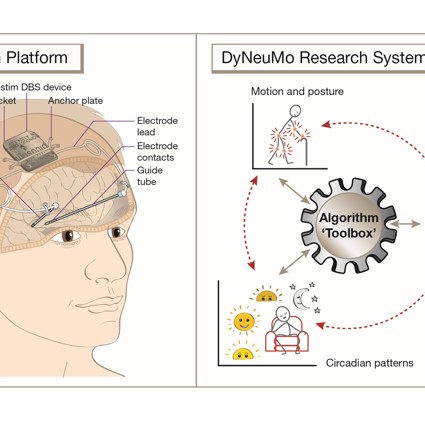 Image of how the device works in the brain.