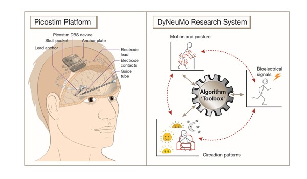 Image of how the device works in the brain.