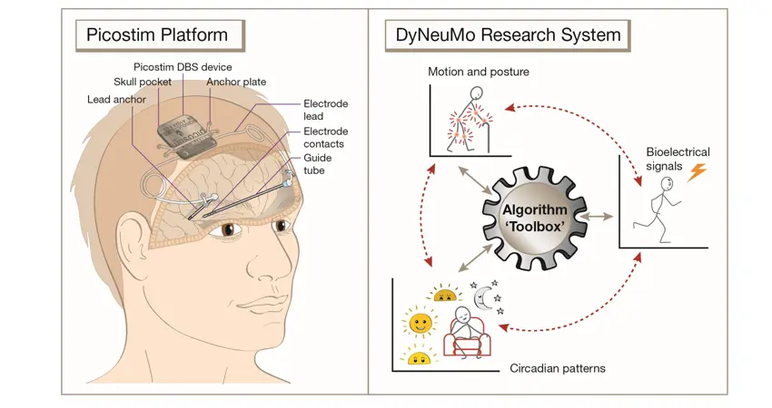 Image of how the device works in the brain.
