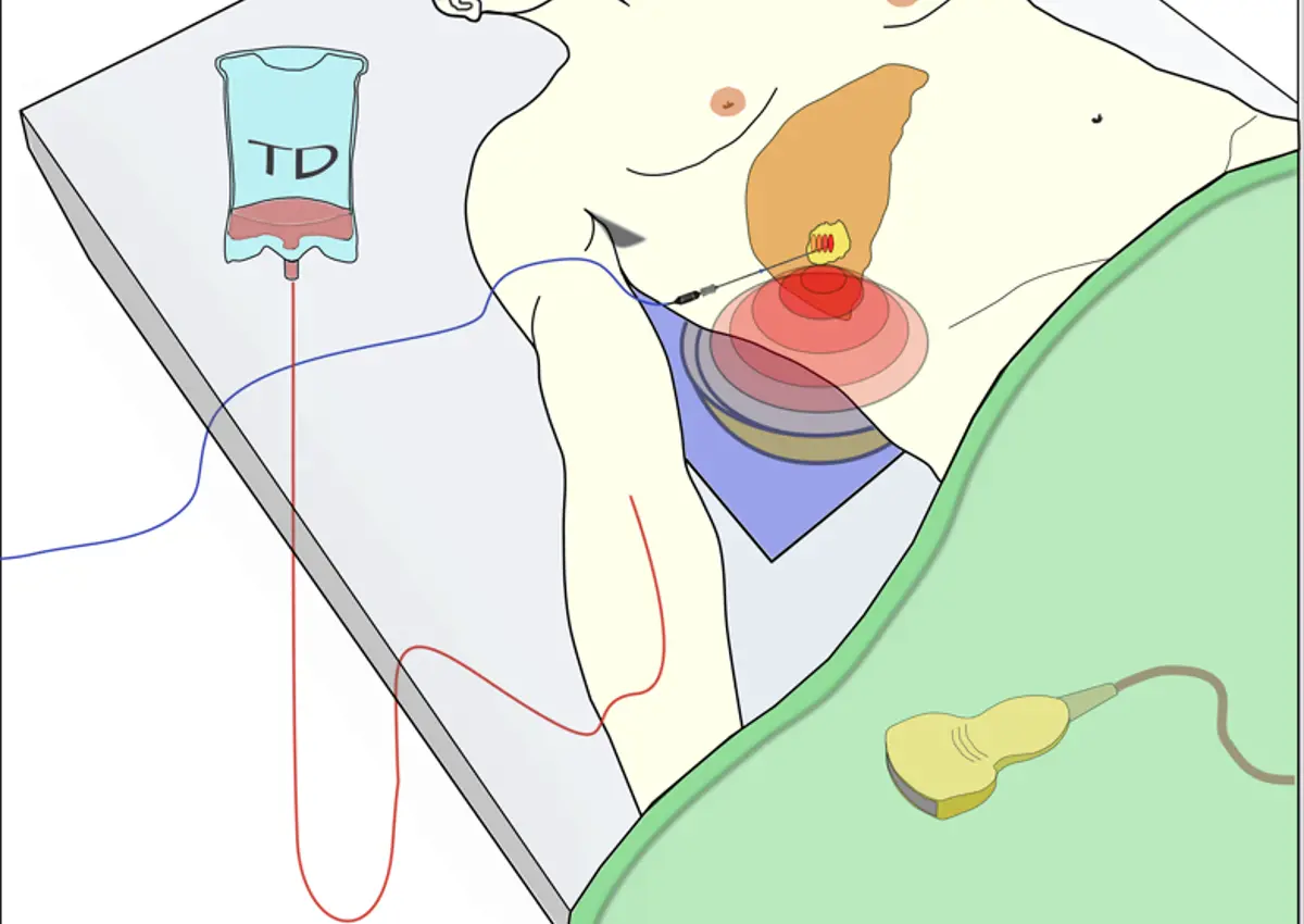 Diagram showing intravenous dose of Thermodox being given to patient lying on hospital bed, with target tumour shown as being heated using ultrasound