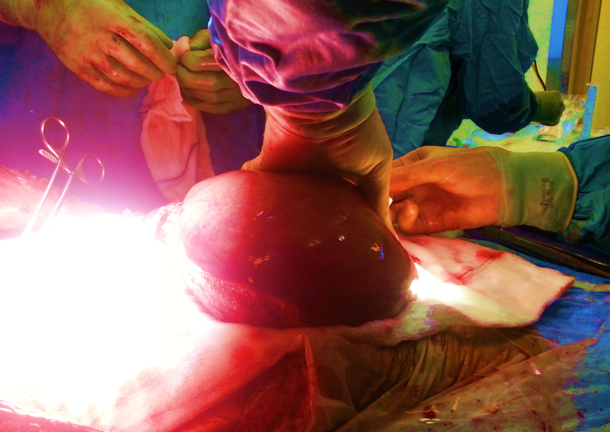 Liver transplantation operation in process