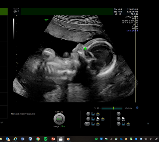 Freeze frame of eye tracking used on sonographer during scan