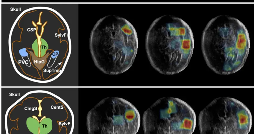 Fetal brain ultrasound used in developing machine learning algorithms to analyse images on mobile devices