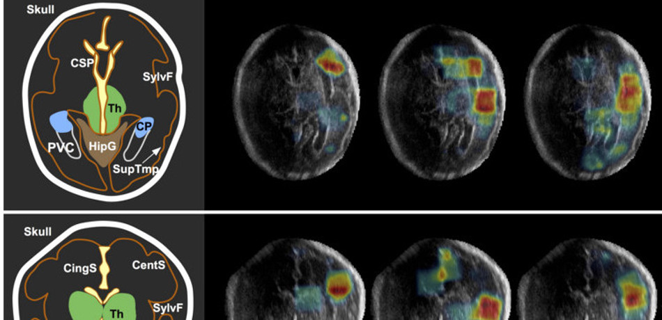 Fetal brain ultrasound used in developing machine learning algorithms to analyse images on mobile devices