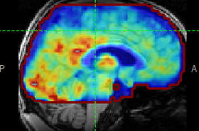 Brain ultrasound image