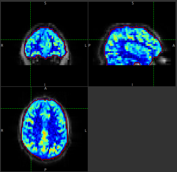 ASL Perfusion Image in Quantiphyse