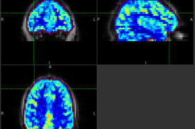 ASL Perfusion Image in Quantiphyse