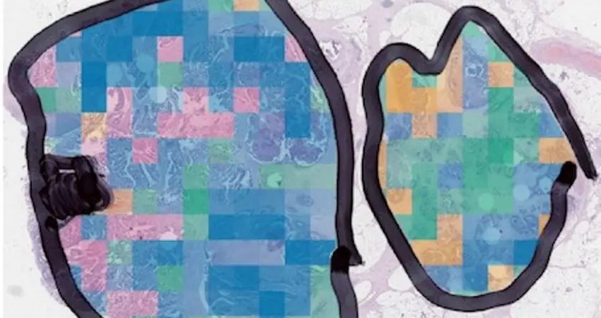 Colorectal cancer diagram
