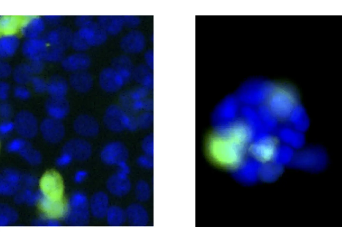 Colon cancer cells shown before and after the perturbation of a gene showing levels of genes reduced by experimental techniques