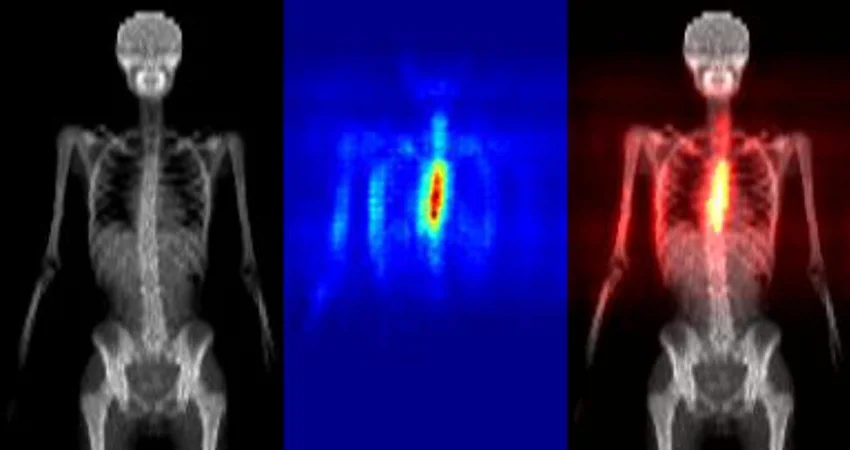 Heatmaps produced automatically that indicate the region of the total body scan that contributed to the decision that scoliosis was present