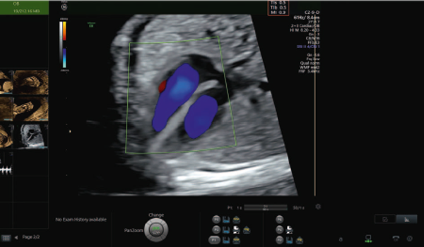 A frame recorded during a routine ultrasound scan. The safety markers are displayed in the top-right of the ultrasound image.