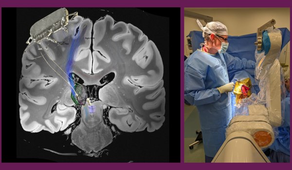 Study tests whether deep brain stimulation can treat chronic pain