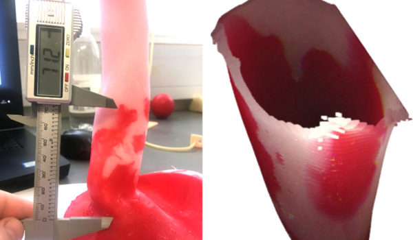 I-driven 3D reconstruction of Barrett’s oesophagus