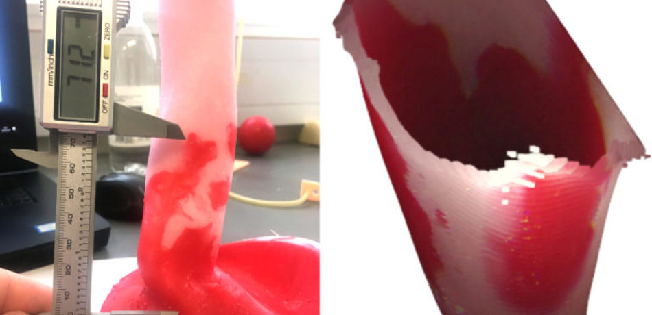 I-driven 3D reconstruction of Barrett’s oesophagus
