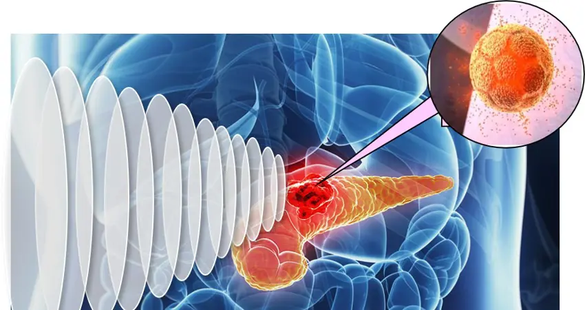 Pandox ultrasound for cancer