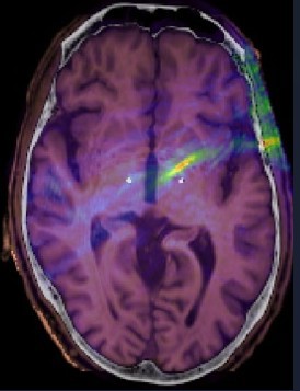 An overlay of the predicted ultrasound field (blue-red) on a two-dimensional image of the skull and brain showing the targeting accuracy of the lens.