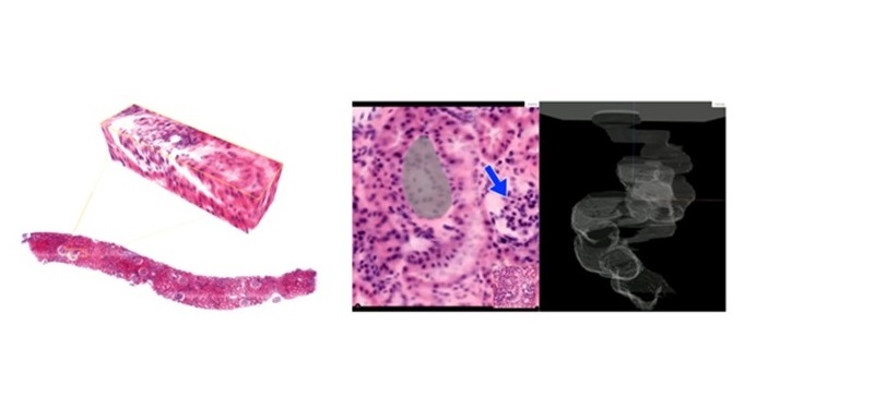 Left: Shown is a three-dimensional image of a kidney biopsy. (Right) Important anatomical landmarks such as tubule, which is shown in gray and a glomerulus, which is a tiny network of blood vessels that is responsible for filtering the blood. 