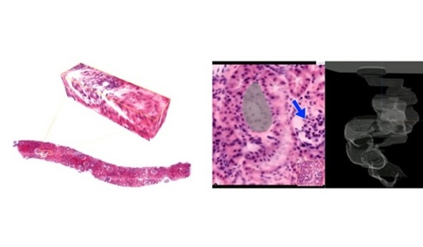 Left: Shown is a three-dimensional image of a kidney biopsy. (Right) Important anatomical landmarks such as tubule, which is shown in gray and a glomerulus, which is a tiny network of blood vessels that is responsible for filtering the blood. 