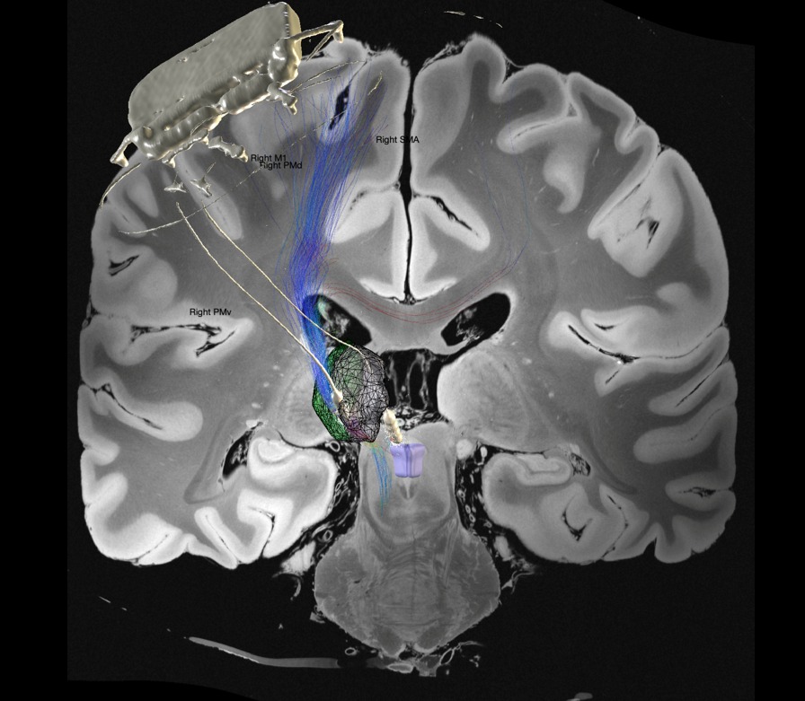 A composite image of the patient’s CT scan showing the Picostim DyNeuMo device and its leads, superimposed on a generic MRI scan of a patient, to illustrate how the device is implanted in the skull, with the leads tips in the sensory thalamus and periaqueductal grey, key areas in the brain’s pain network. The EPIONE study is looking at whether stimulating these areas may help develop new ways to reduce pain. The coloured tracts from the cortex illustrate key sensory pathways in the brain.