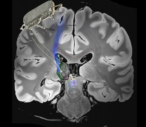 A composite image of the patient’s CT scan showing the Picostim DyNeuMo device and its leads, superimposed on a generic MRI scan of a patient (using a programme called Lead-DBS), to illustrate how the device is implanted in the skull, with the leads tips in the sensory thalamus and periaqueductal grey, key areas in the brain’s pain network. The EPIONE study is looking at whether stimulating these areas may help develop new ways to reduce pain. The coloured tracts from the cortex illustrate key sensory pathways in the brain.