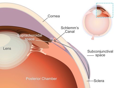 A schematic of the eye’s anterior segment, demonstrating the anatomical placement of the microstent. The stent diverts aqueous humour from the anterior chamber to the suprachoroidal space through the flexible tube, creating a subconjunctival bleb supported by the expanding element.