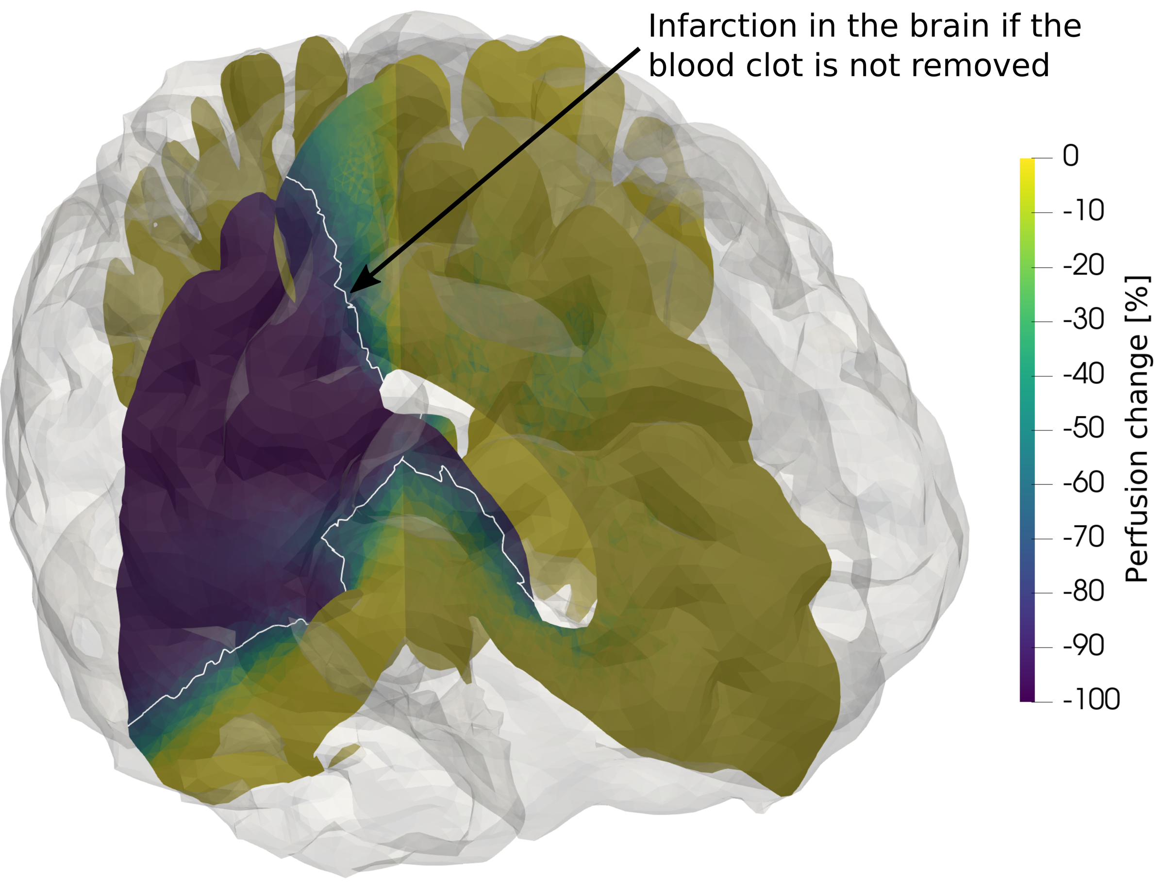 An ‘infarction’ (region of dead tissue) forms from a lack of blood supply, caused by a blood clot. Credit: Tamás Józsa