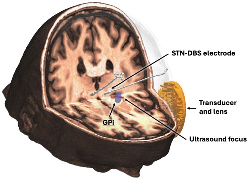 Schematic showing ultrasound transducer and lens (orange); focal spot (red); global pallidus (blue) and the sensing electrodes in the subthalamic nucleus (white).